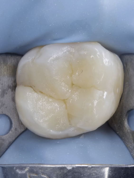 Depois: restauração em resina com anatomia oclusal reproduzida